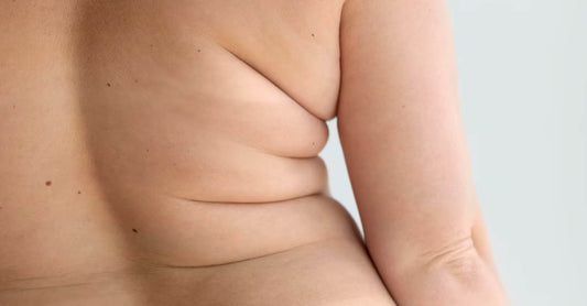 Can Obesity or Weight Gain Cause Skin Tags?