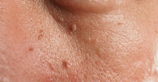 The Science Behind Skin Tags Prevention (2023)