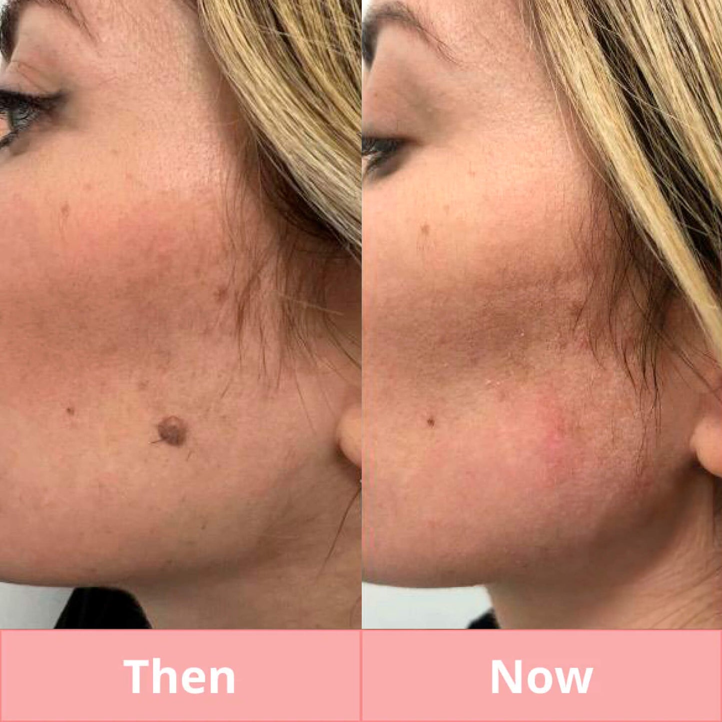 Skintify™ Remover Pen for Moles