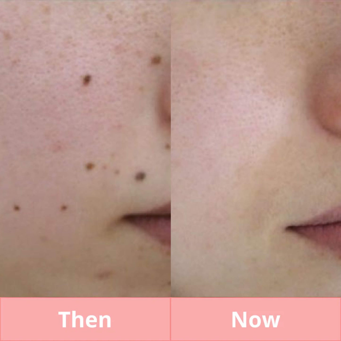 Skintify™ Remover Pen for Warts