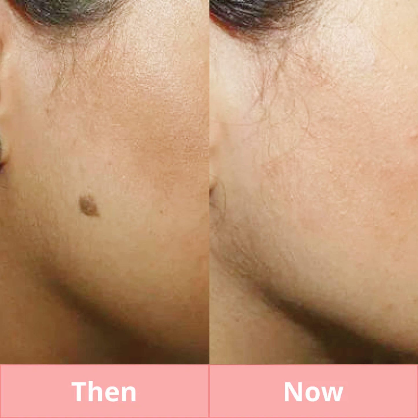 Skintify™ Remover Pen for Moles