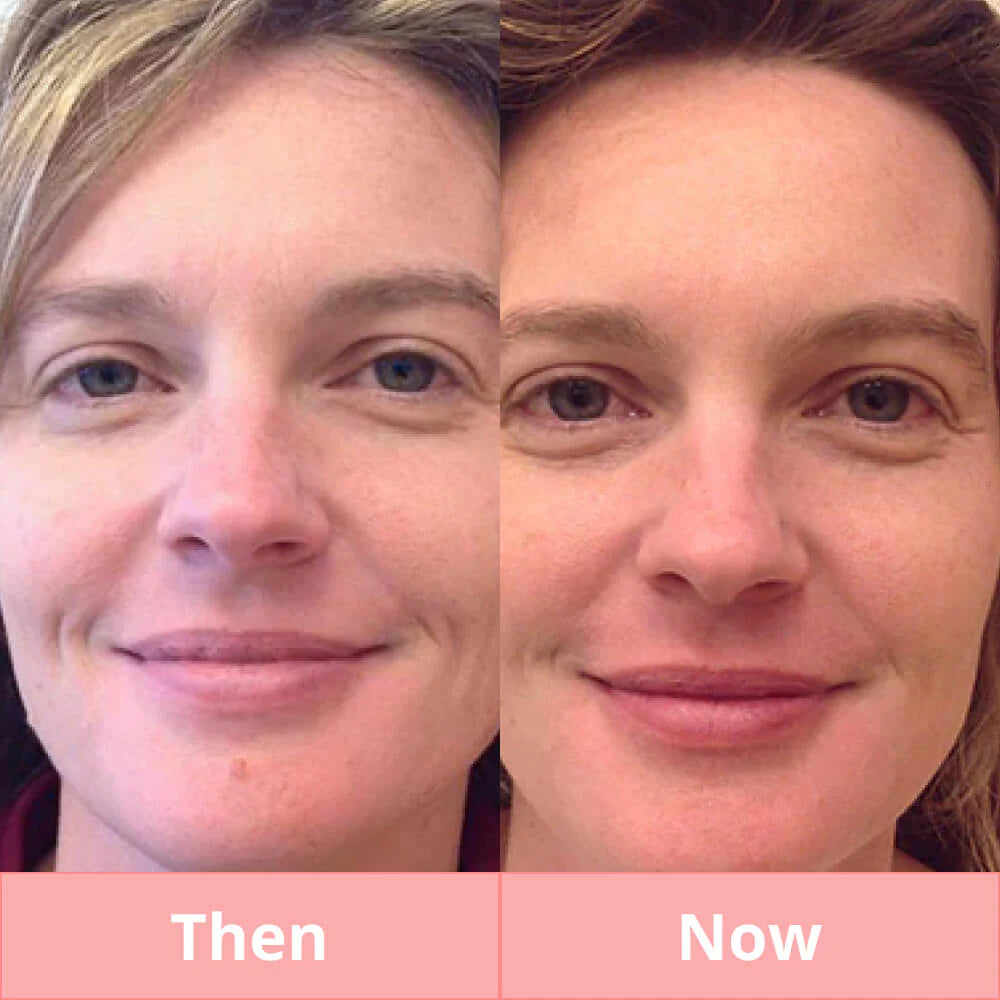 Skintify™ Remover Pen for Warts