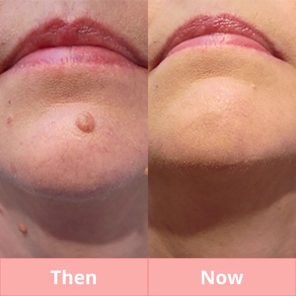 Skintify™ Remover Pen for Warts