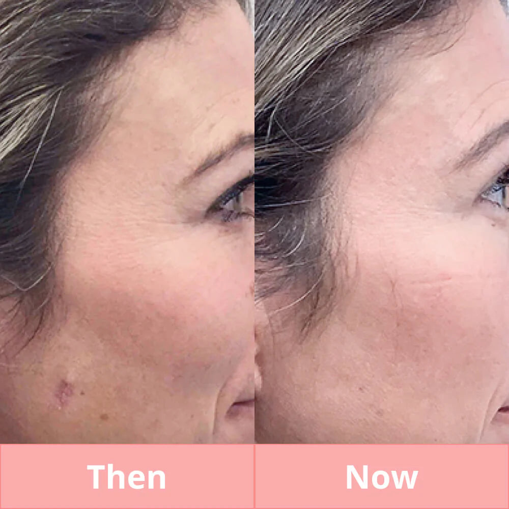 Skintify™ Remover Pen for Warts