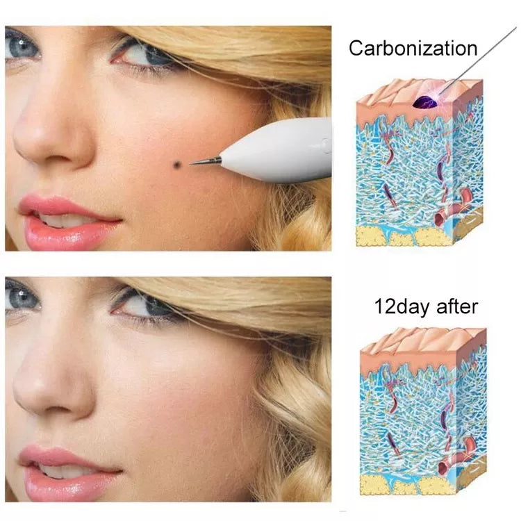 Skintify™ Remover Pen for Moles, Skin Tags, Warts, Age Spots, Freckles | B