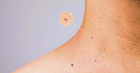 skin tags - image