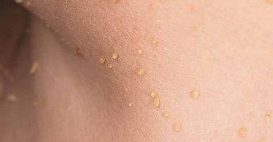 The Ultimate Guide to Removing Skin Tags under Breasts