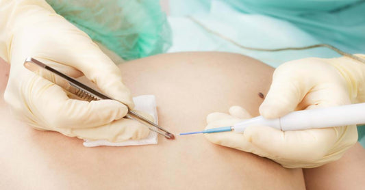 Skin Tags Medical Guide: Should You Get Surgery?