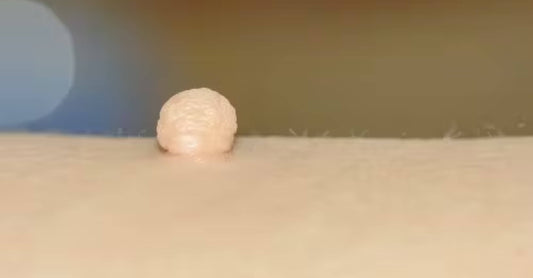 Best Ways Remove Annoying Skin Tags on Sensitive Areas