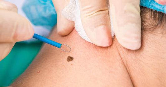 How Cauterization and Electrocautery Works (Skin Tags)