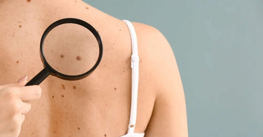 The Real Cost of Doing Laser Skin Tag Removal (2023)