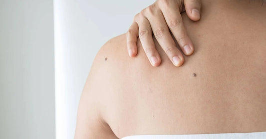 Best 3 Electric Remover Pens in Skin Tags