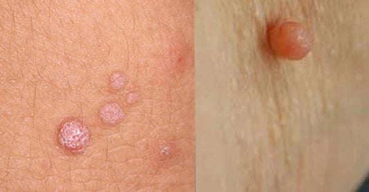 Skin Tag vs. Wart: Understanding the Difference