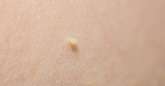 Skin Tags in Pictures: Visual Reference and Identification