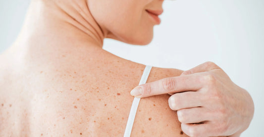 3 Best Compound W Options to Remove Your Skin Tags