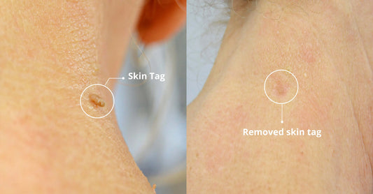 Evaluating 5 Best Home Skin Tag Kits in 2023