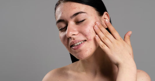 How to Skin Tag Aftercare Using This Smooth Routine
