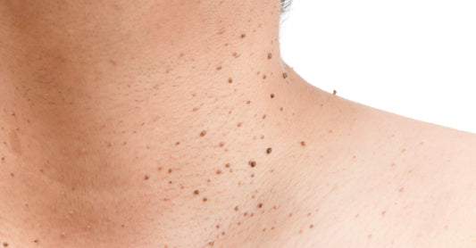 Understanding Skin Tags Different Types &amp; Appearances