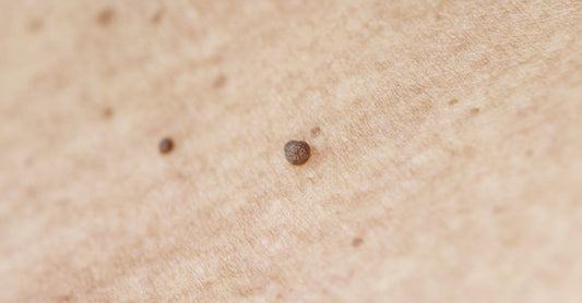 What Are Skin Tags? Where to Get Them Removed?