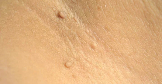 How to Remove Skin Tags on the Genital Area (2023)