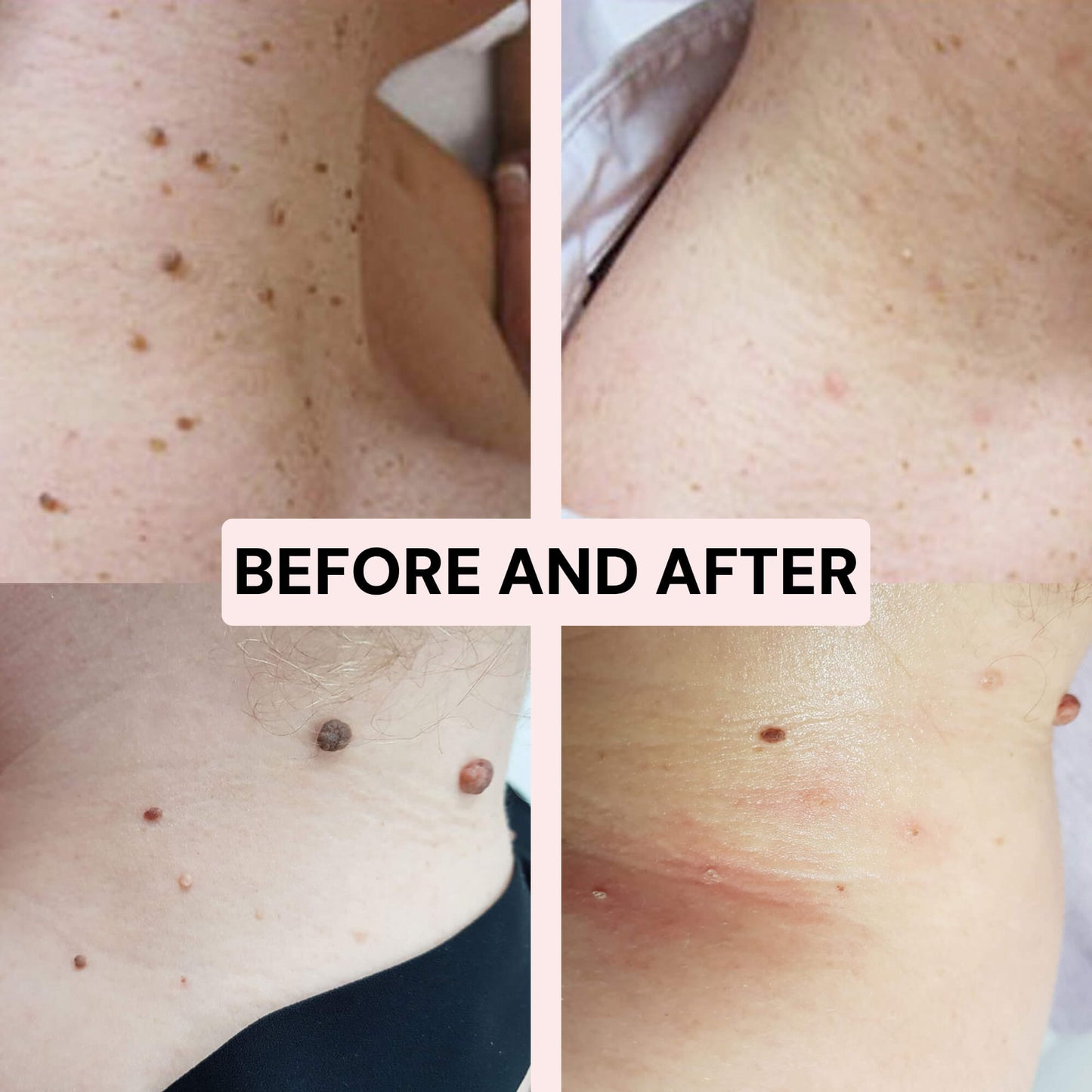 Skintify™ Remover Pen for Moles, Skin Tags, Warts, Age Spots, Freckles | Starter Kit