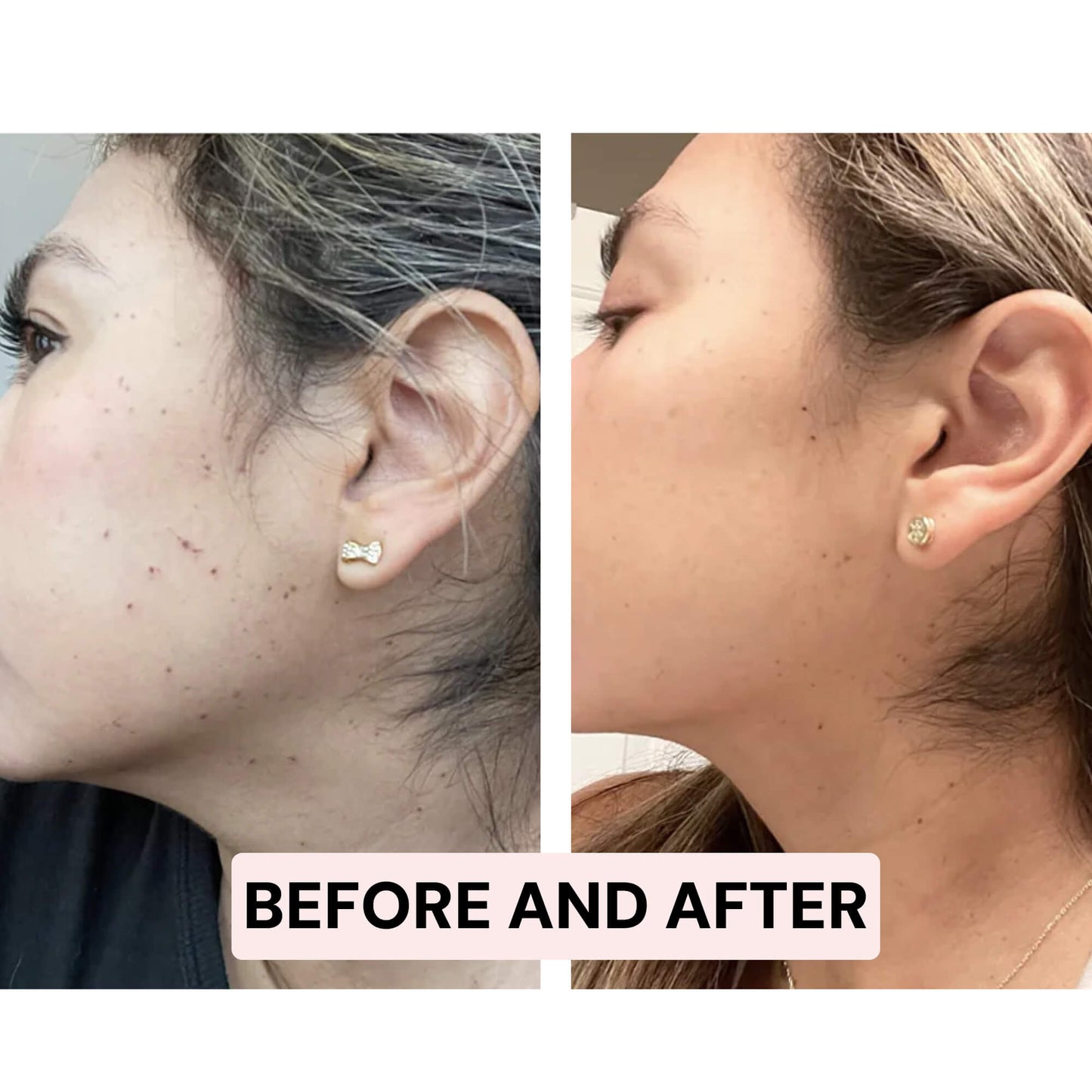 Skintify™ Remover Pen for Moles, Skin Tags, Warts, Age Spots, Freckles | Starter Kit
