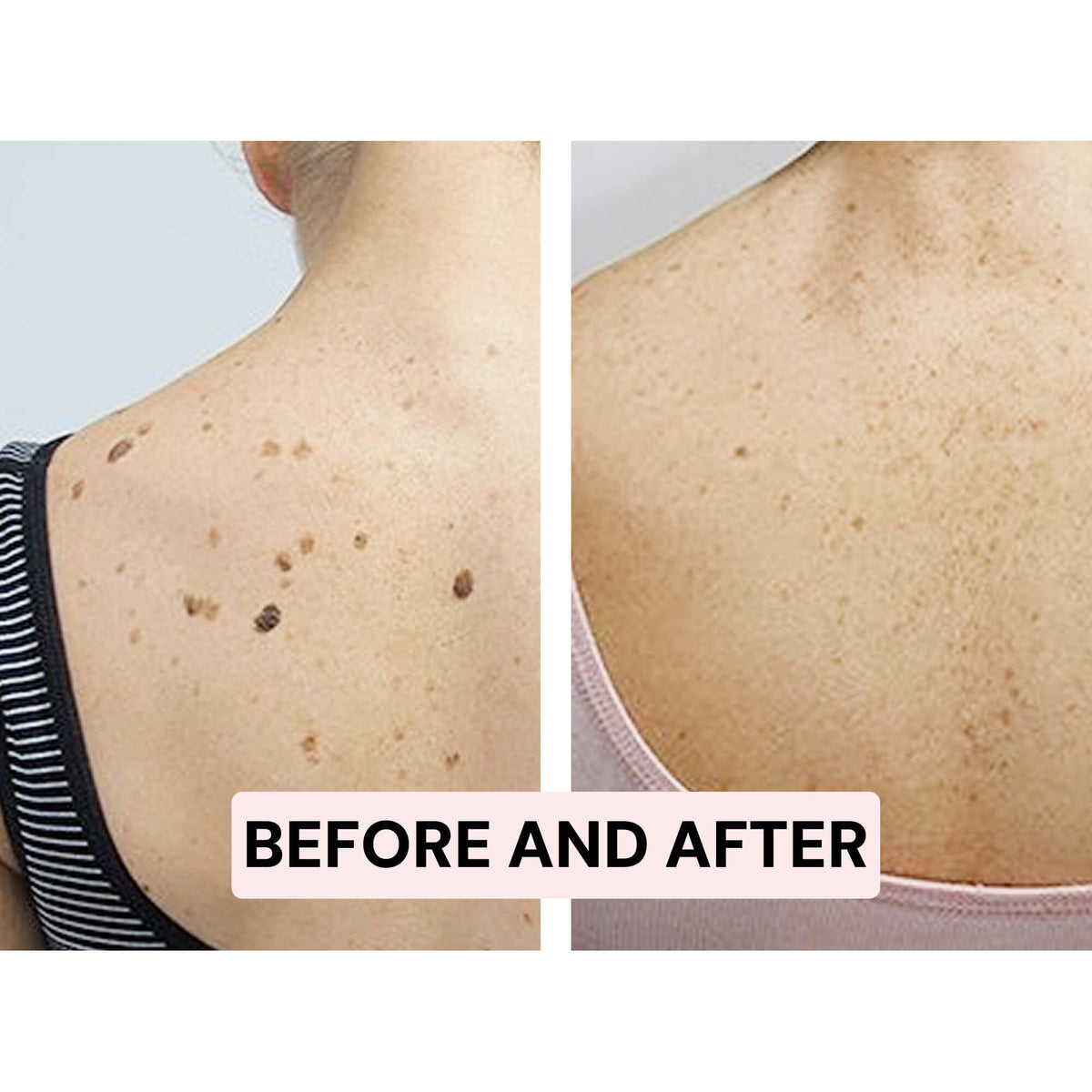 Skintify™ Remover Pen for Moles, Skin Tags, Warts, Age Spots, Freckles