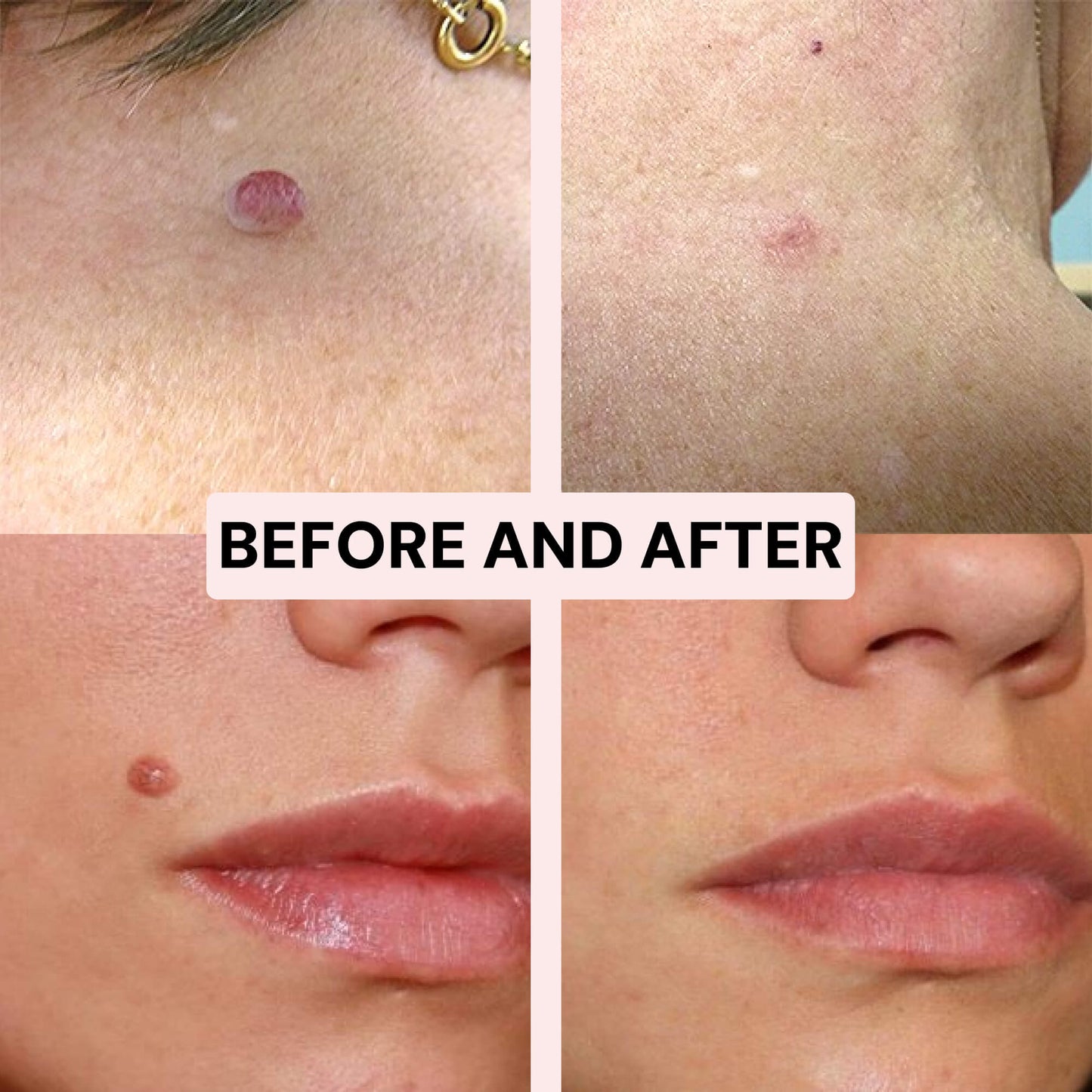 Skintify™ Remover Pen for Moles, Skin Tags, Warts, Age Spots, Freckles | Starter Kit