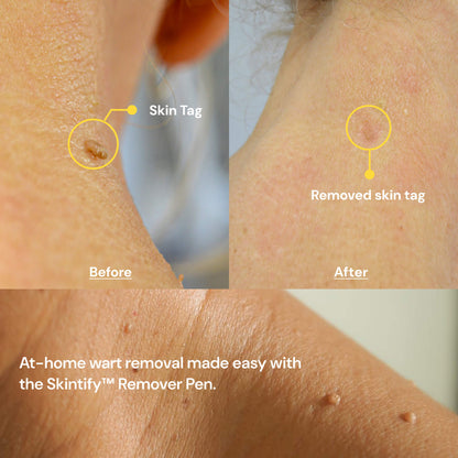 Skintify™ Remover Pen for Moles, Skin Tags, Warts, Age Spots, Freckles | Starter Kit