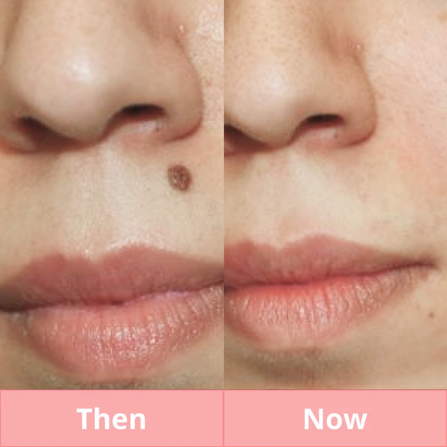 Skintify™ Remover Pen for Moles