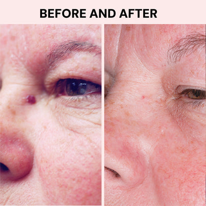 Original Skintify #1 Fibroblast Plasma Pen