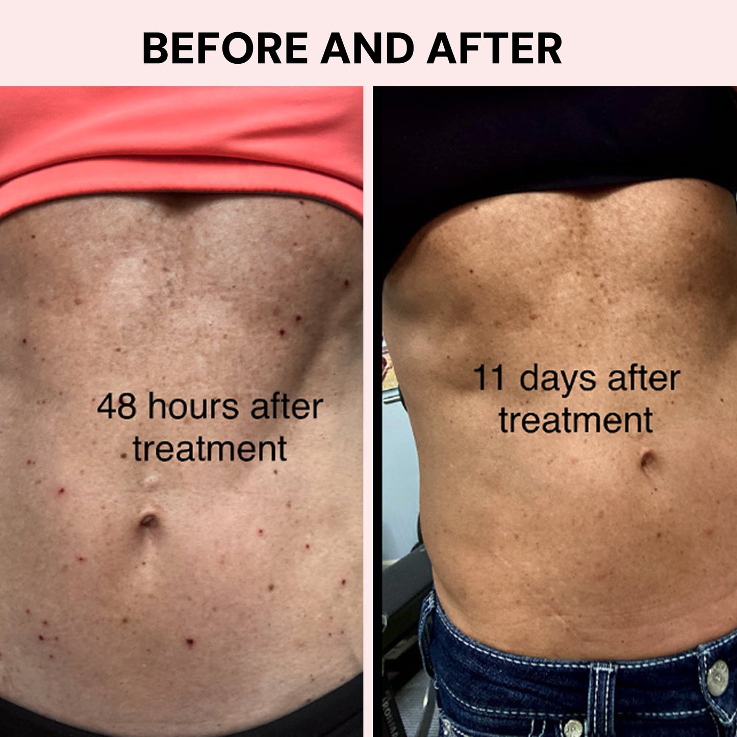 Original Skintify #1 Fibroblast Plasma Pen