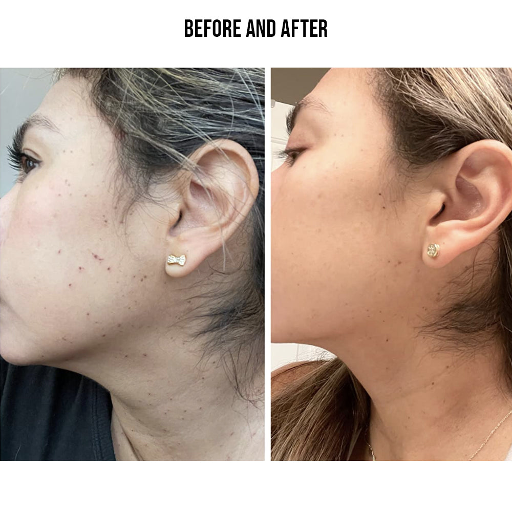 MOLE REMOVAL PEN BEFORE AND AFTER UPDATE // New Mole and Skin Tag