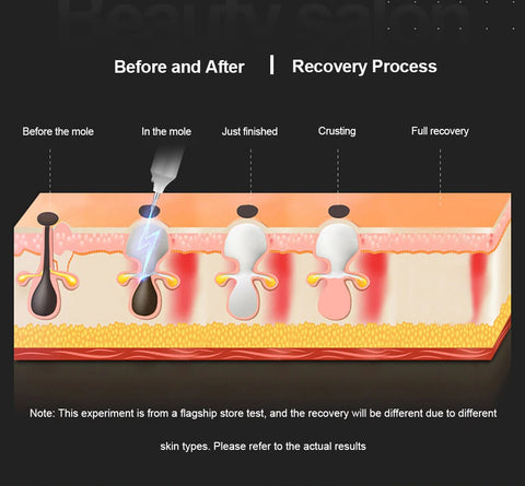 Skintify™ Remover Pen for Warts on Hands, Face, Feet and More